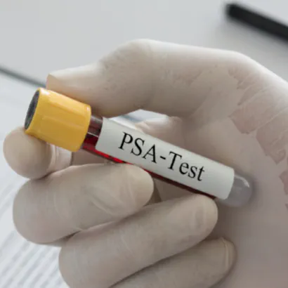 PSA: quando iniziare a controllarlo? Non esiste la stessa età per tutti